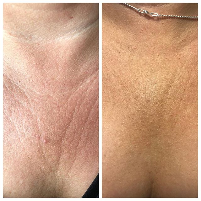 One® Chest Wrinkle Patches (Reusable)