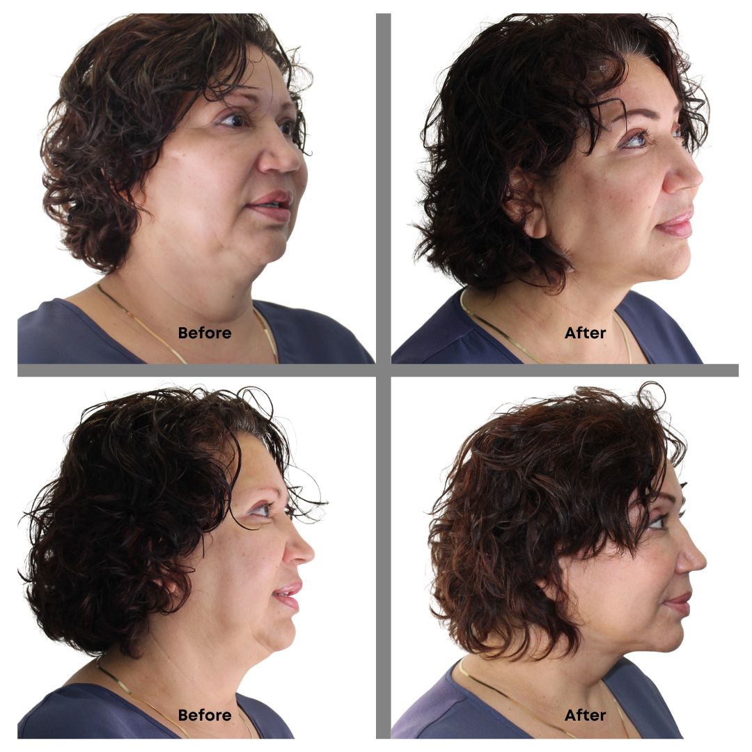 One® Natural Instant Lift Neck Tape (20 Strips)
