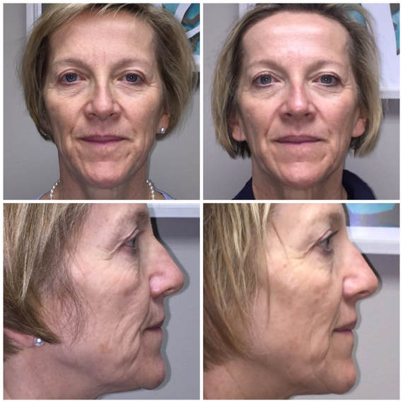 Gua Sha Facial Set (2 Pieces)